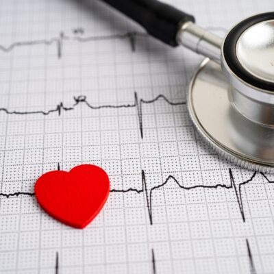 An Electrocardiogram (ECG)